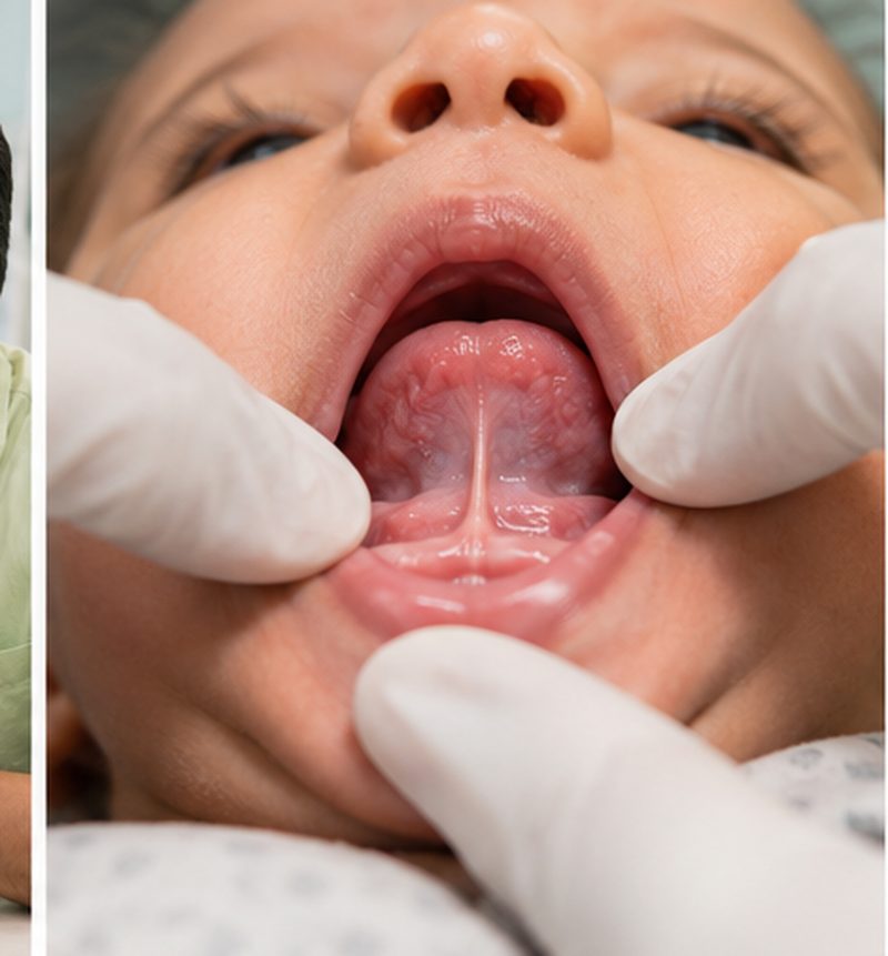 Tongue tie laser treatment