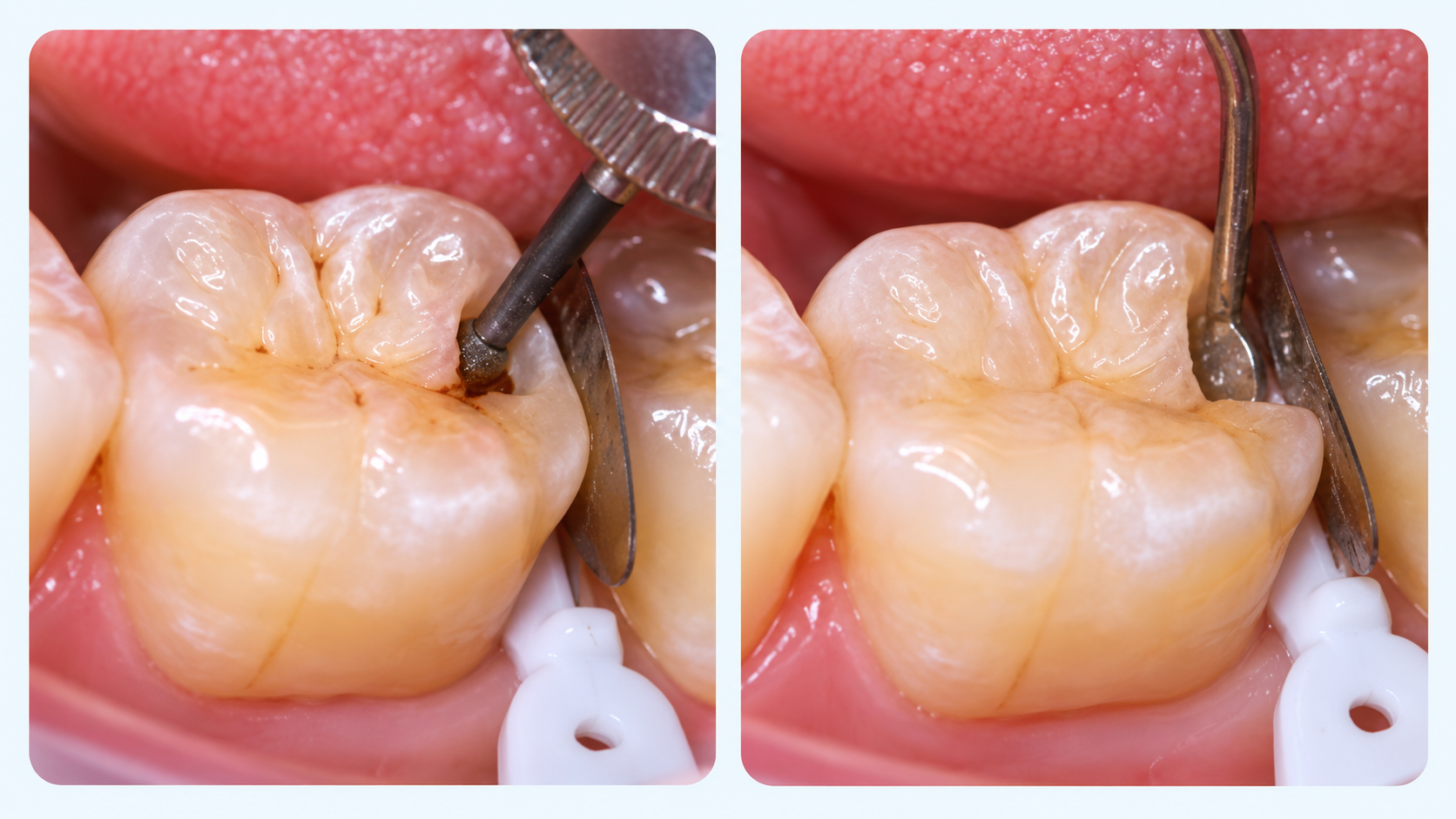 Before and after comparison of root canal decay removal