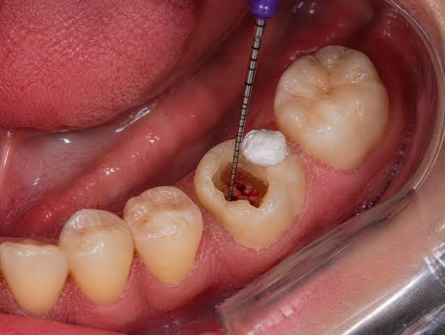 Close-up of root canal file inside tooth canal